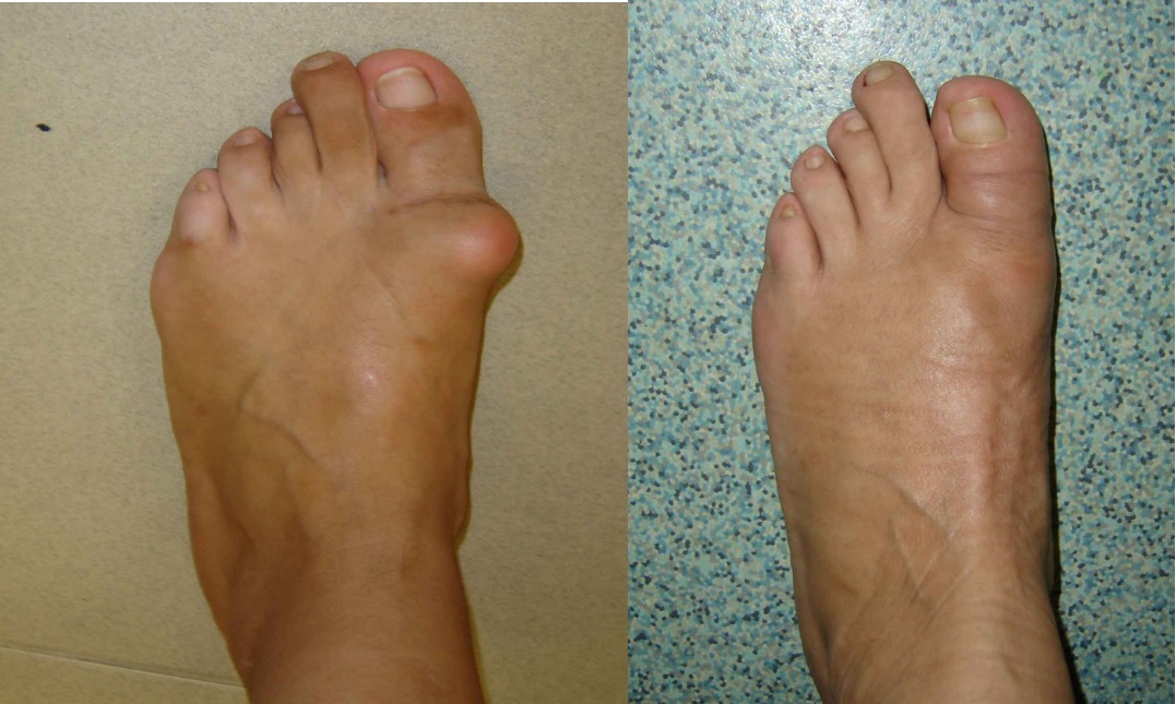 Apa la genunchi – simptome, cauze si tratament