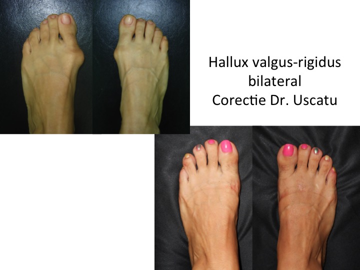 tratamentul articulației piciorului hallux valgus
