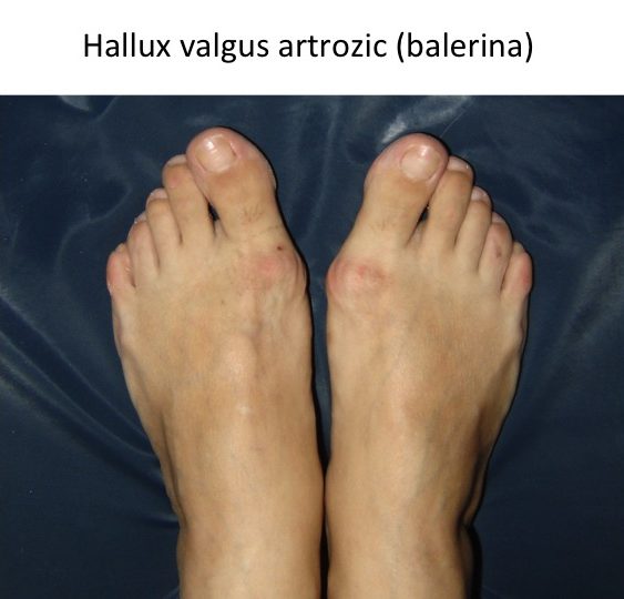 artroza tratează picioarele picioarelor)