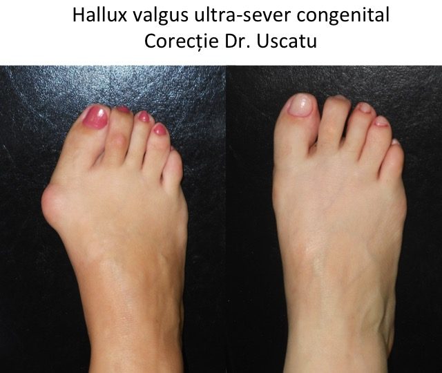 Tratamentul curburii Hallux valgus)