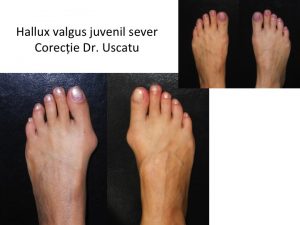 HV ultra-sever bilateral juvenil