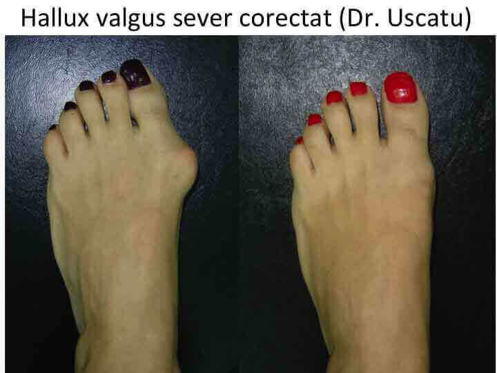 Hallux Valgus pre-post Ior