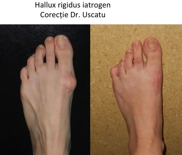 Hallux rigidus iatrogen