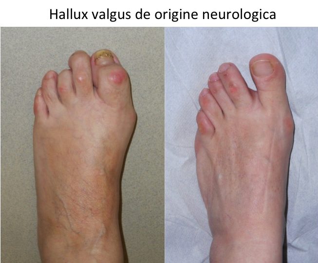 Hallux valgus de origine neurologica