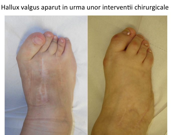 Hallux valgus iatrogen 2