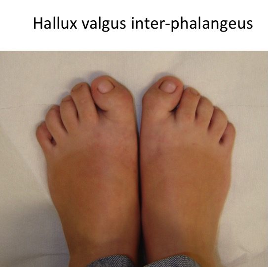 Hallux valgus inter-phalangeus