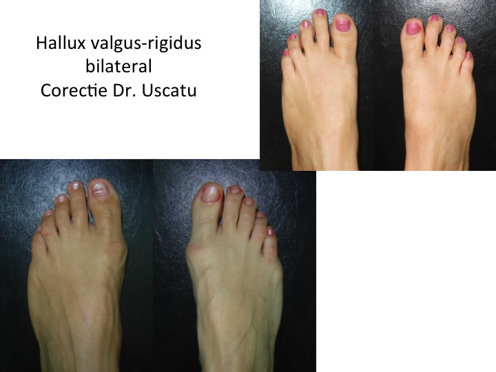 Hallux valgus-rigidus bilateral Ial