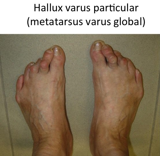 Hallux varus MT varus global