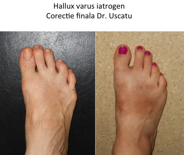 Hallux varus corectat Chi