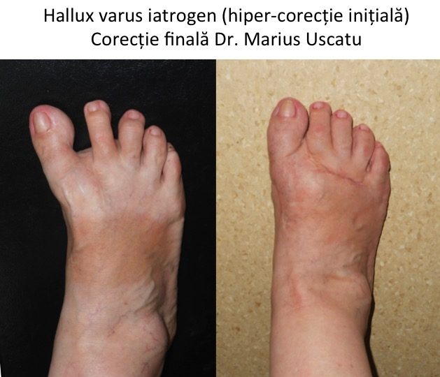 Hallux varus corectat