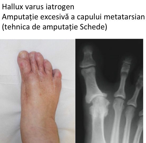 Hallux varus iatrogen Schede