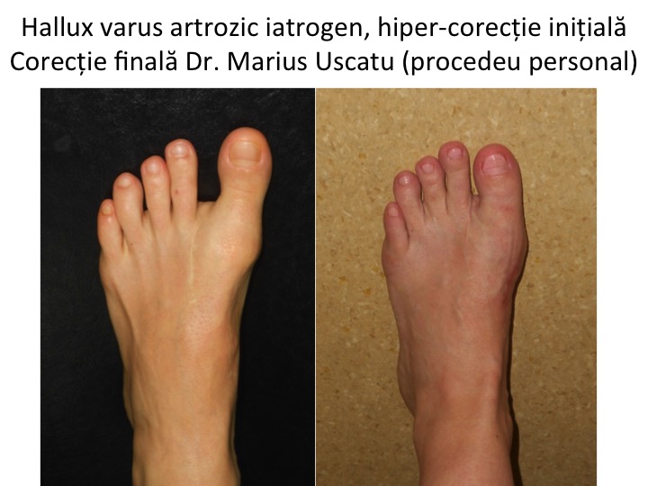 Hallux varus iatrogen Vlas 1