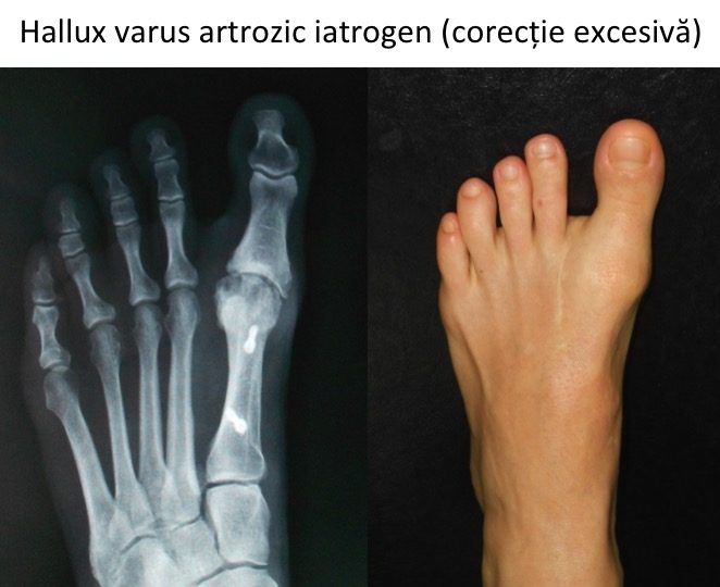 Hallux varus iatrogen Vlas