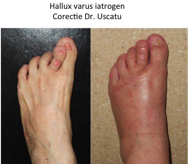 Hallux varus iatrogen