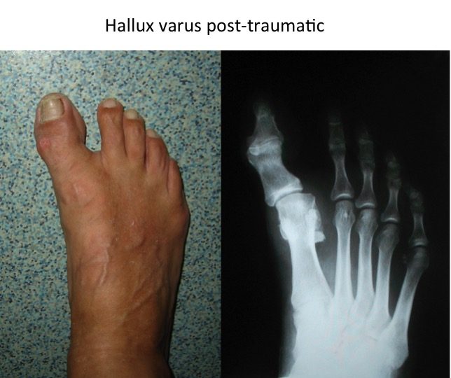 Hallux varus post-traumatic