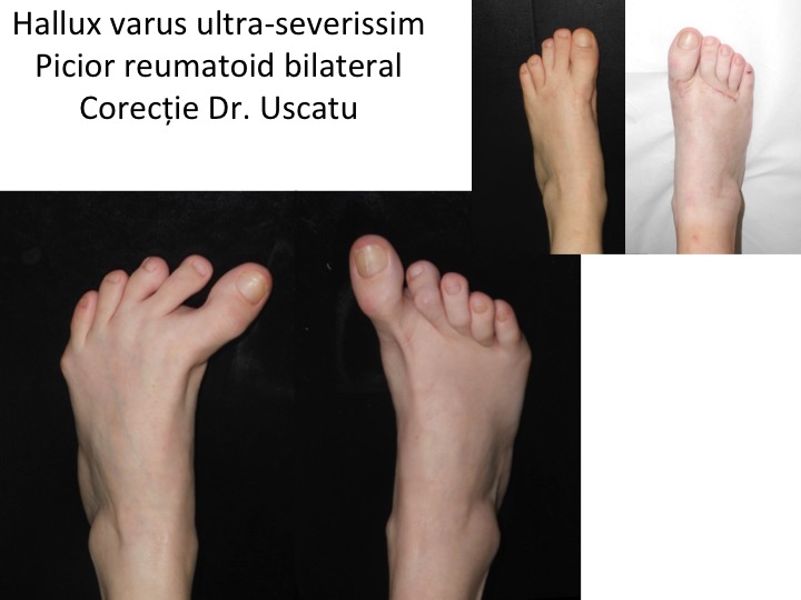 Hallux varus reumatoid bilateral Cap