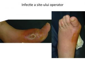 Infectie Maz