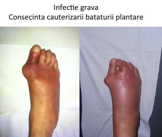 Infectie grava dupa indepartarea bataturii