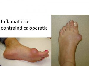 Inflamatie