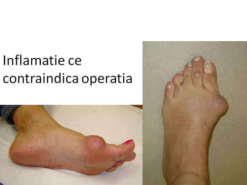 picior inflamat