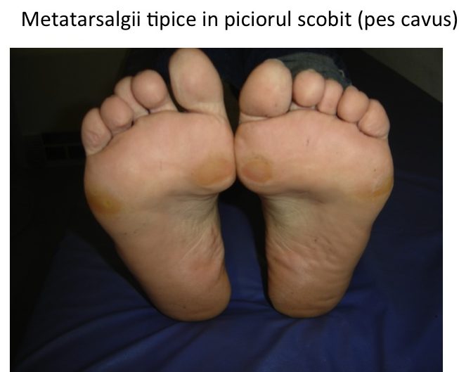 MT 1 si 5 pes cavus