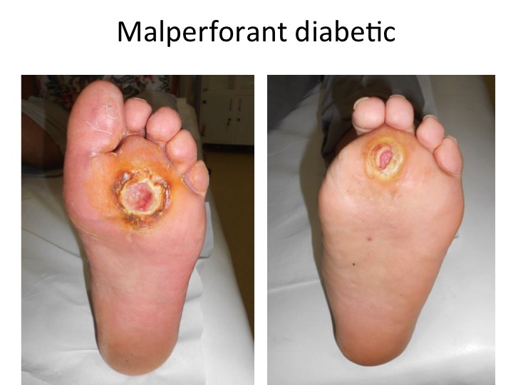 Malperforant diabetic