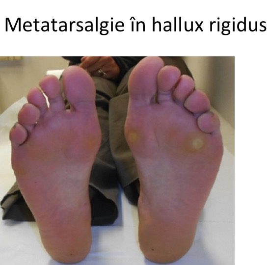 Metatarsalgie HR