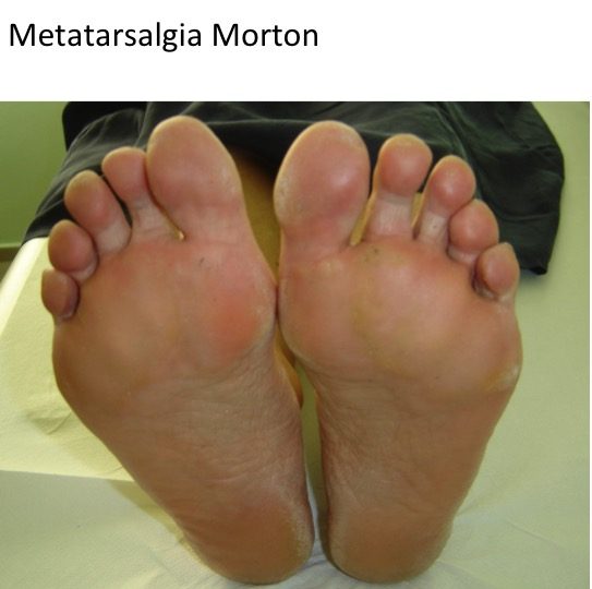 Metatarsalgie Morton