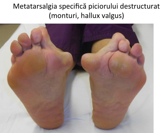 Monturi Picioare Hallux Valgus Operatie Sau Tratament Conservator