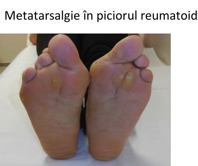 Metatarsalgie picior reumatoid