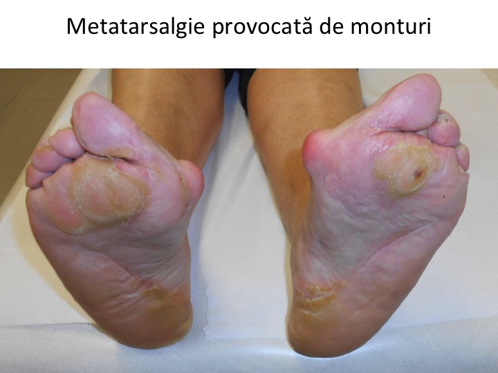 Metatarsalgii Hallux valgus