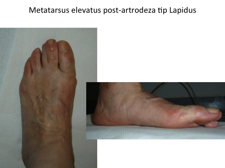 Metatarsus elevatus post Lapidus