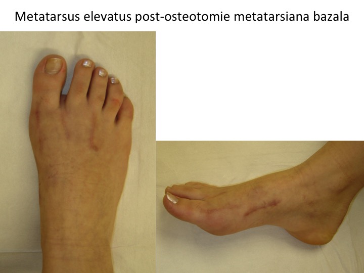 Metatarsus elevatus post osteotomie bazala