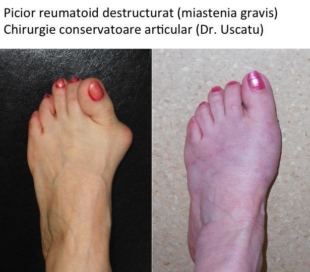 artrita reumatoidă a piciorului decât pentru a trata