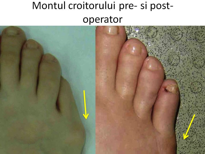 Montul croitorului pre- si post-operator