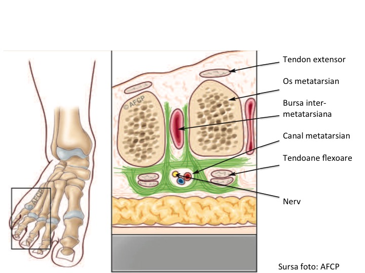 Morton Anatomie