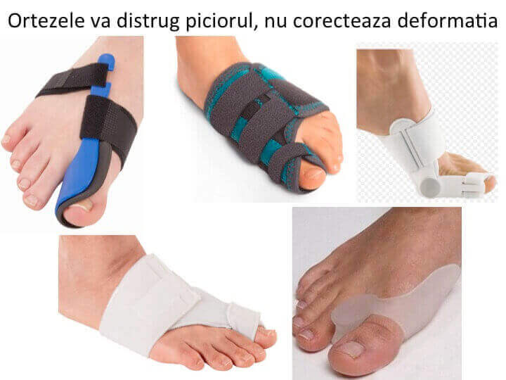 dispozitiv de tratare a artrozei piciorului)