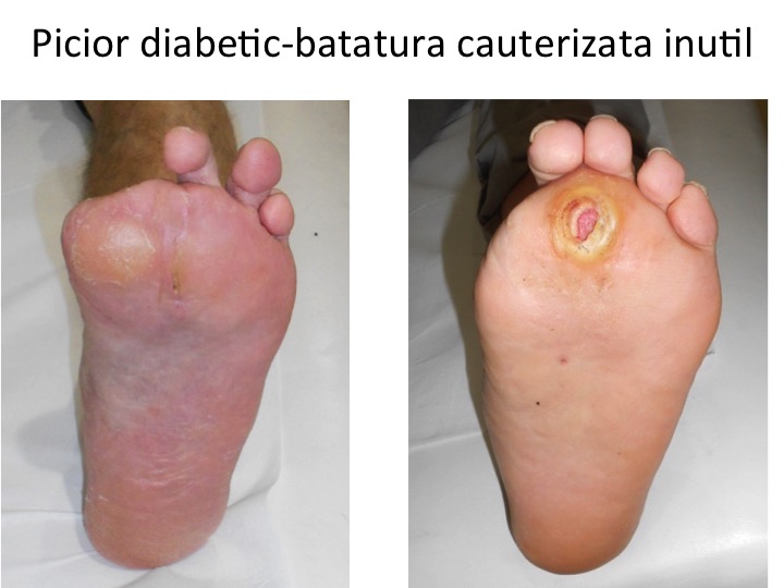 Picior diabetic-batatura cauterizata inutil