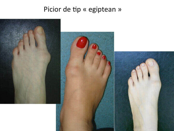 Picior egiptean