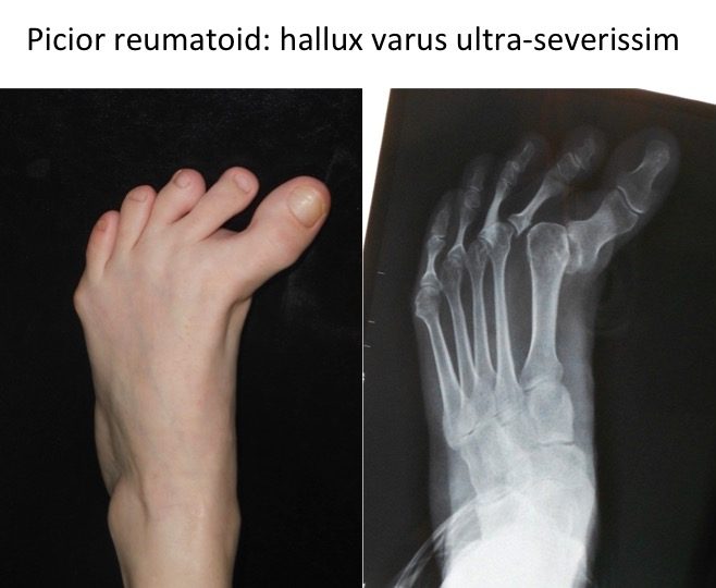 Picior reumadoid hallux varus