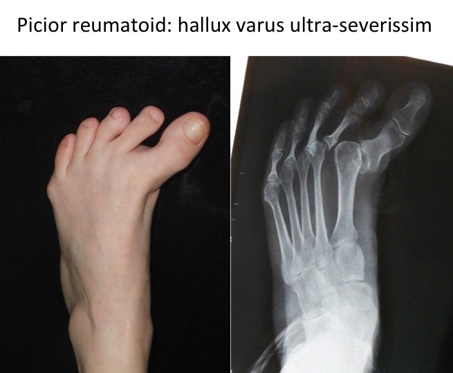 Picior reumadoid hallux varus Cap