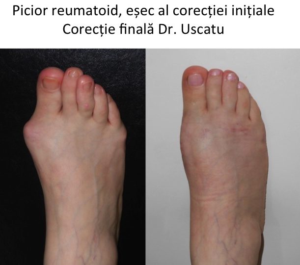 Picior reumatoid Gh