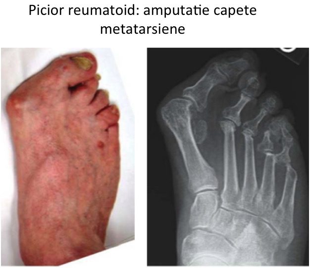 Picior reumatoid Lelievre 1