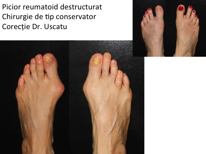 artrita reumatoidă a articulațiilor piciorului