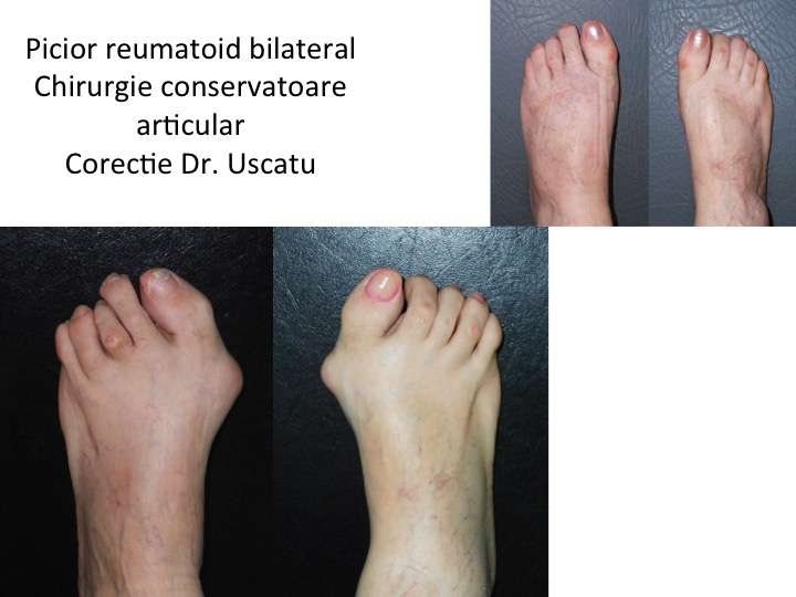 Picior reumatoid bilateral And