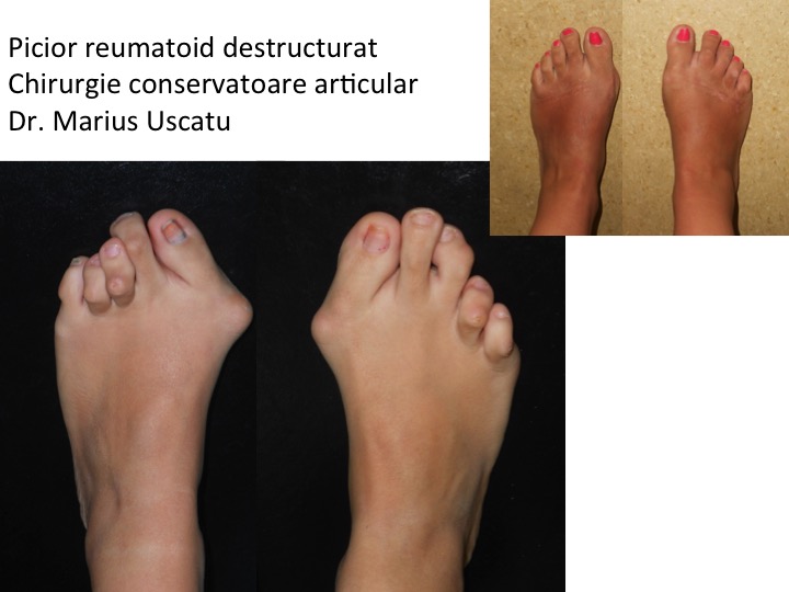 tratamentul leziunilor articulare la picior)