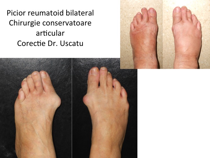 Picior reumatoid bilateral Met