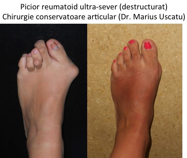 artrita reumatoidă a piciorului)