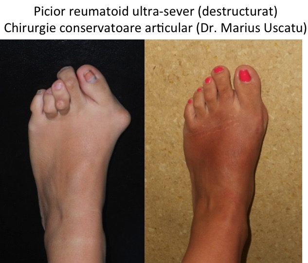 Picior reumatoid chirurgie conservatoare articular BR