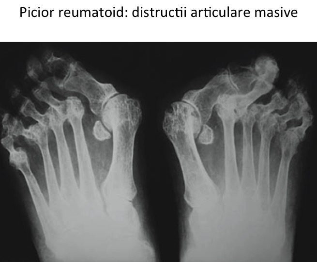 Picior reumatoid-distructii articulare masive